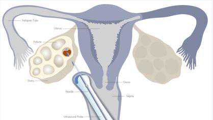 为什么监测卵泡越来越小