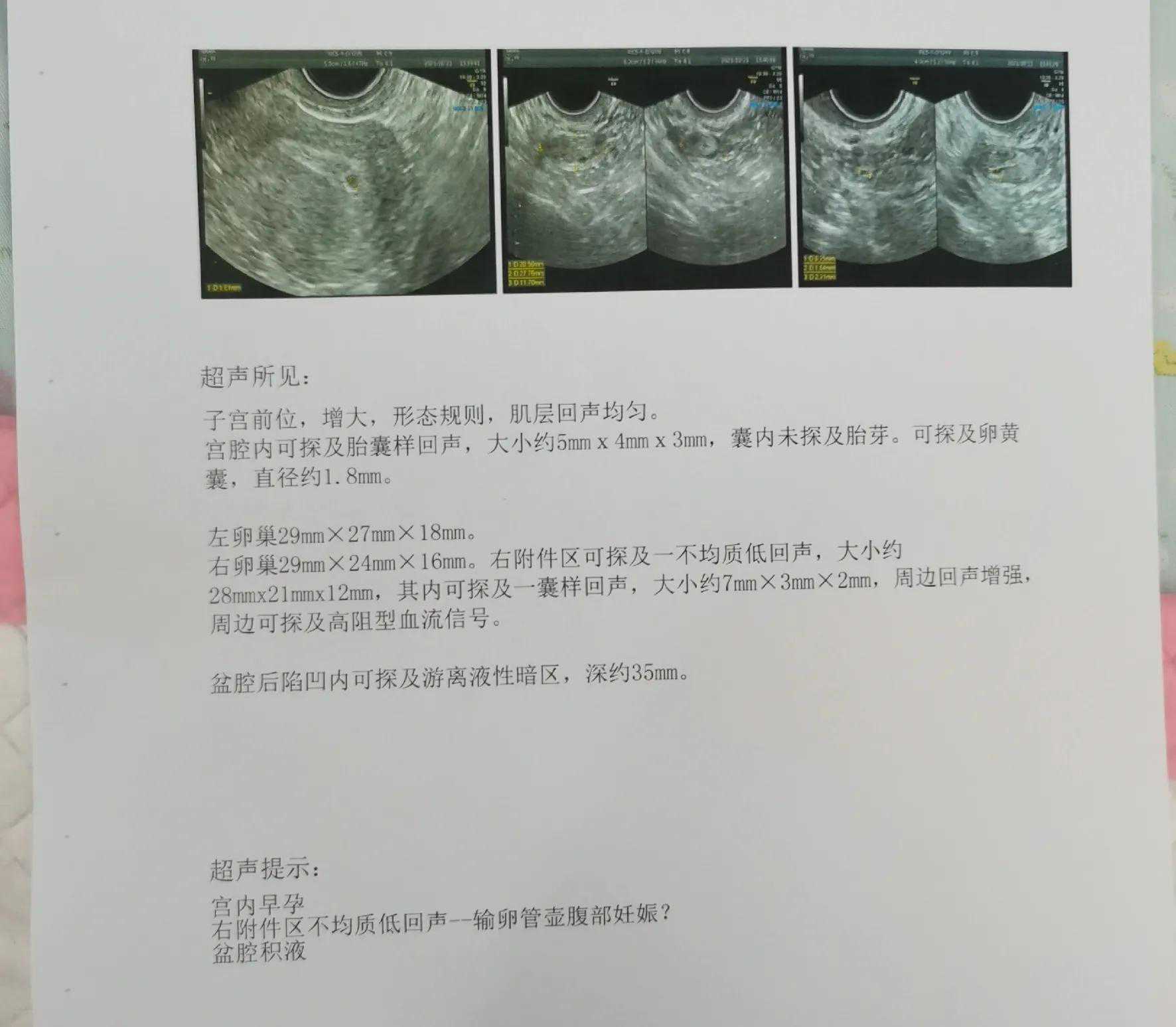 多囊卵巢综合征成长之路-试管移植