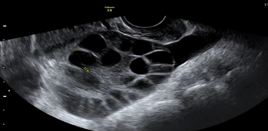 为什么做试管之前要查amh？那这是什么呢？