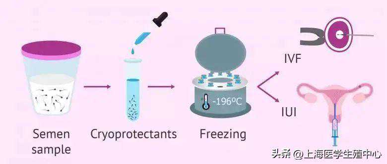 冷冻精子是否会影响试管婴儿的成功率？